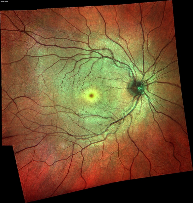 Heidelberg Spectralis 4D eye scan widefield retinal multi colour image showing retina optic nerve and retinal vessels