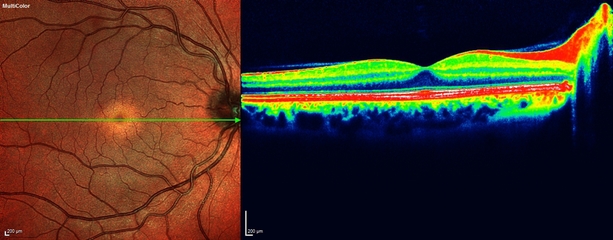 Retinal photograph multi colour image and Heidelberg Spectralis 4D OCT Optical Coherence Tomographer Eye Scan examination of macula to detect early wet and dry macula degeneration and diabetic retinopathy and oedema at opticians Buchanan Optometrists, Kent