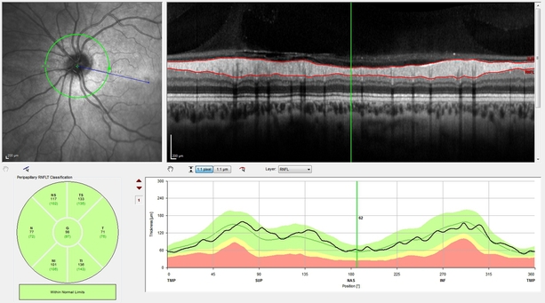 Heidelberg spectralis 4d OCT Optical Coherence Tomographer eye scan examination of retinal nerve fibre RNFL thickness for early glaucoma detection at opticians Buchanan Optometrists, Kent