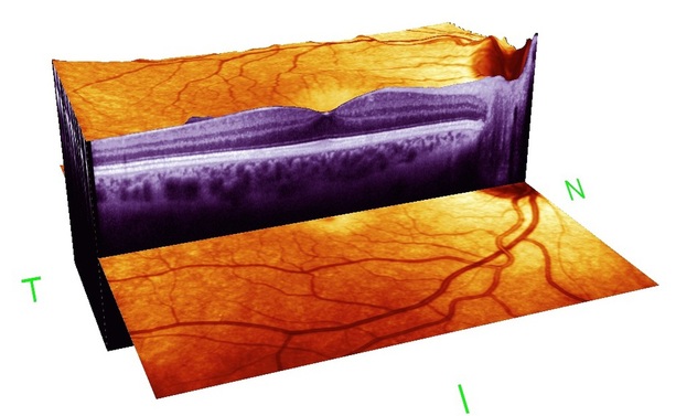 Heidelberg spectralis 4d eye scan examination of macula retinal layers at Buchanan Optometrists Kent