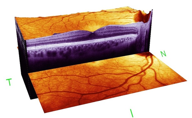 Heidelberg spectralis 4d OCT Optical Coherence Tomographer eye scan examination of posterior pole retinal nerve fiber layers for early glaucoma detection at opticians Buchanan Optometrists, Kent