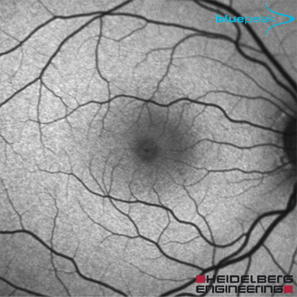 Blue Peak Normal Fundus